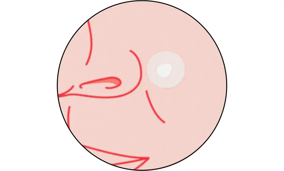 Watch it work. Leave each patch on for 6-8 hours. Patch starts to turn white as it absorbs fluid.