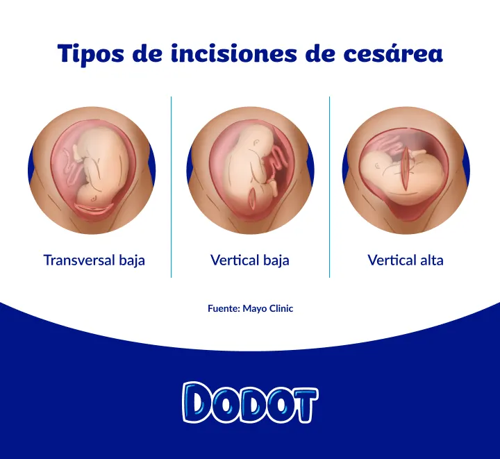Cicatriz de la cesárea: tipos, cuidados y tratamiento | Dodot