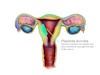 Placenta accreta is where the placenta implants too deeply, into and sometimes through the uterus.  This can make the placenta very difficult to remove and can result in hemorrhage, infection, and hysterectomy (removal of the uterus)