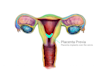 Placenta previa is where the placenta implants over the cervix so the baby can't come out vaginally.