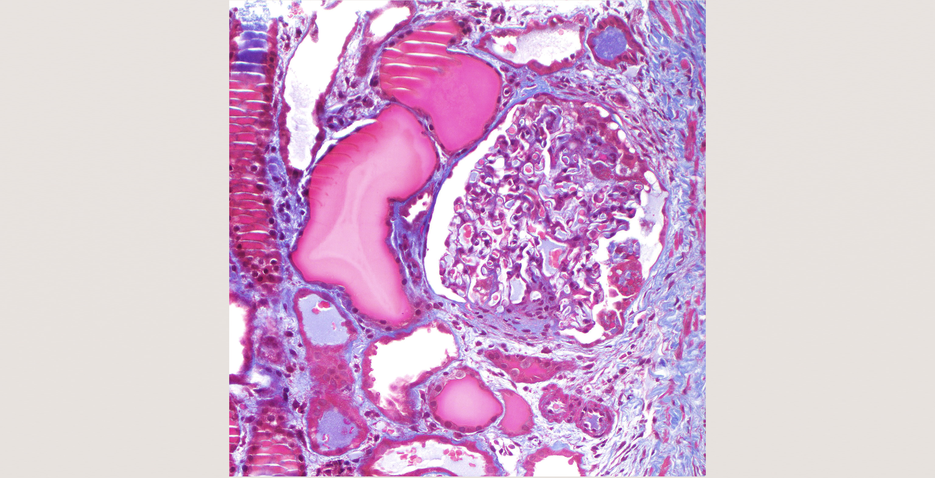 pathology-nephrology-3-p1-3