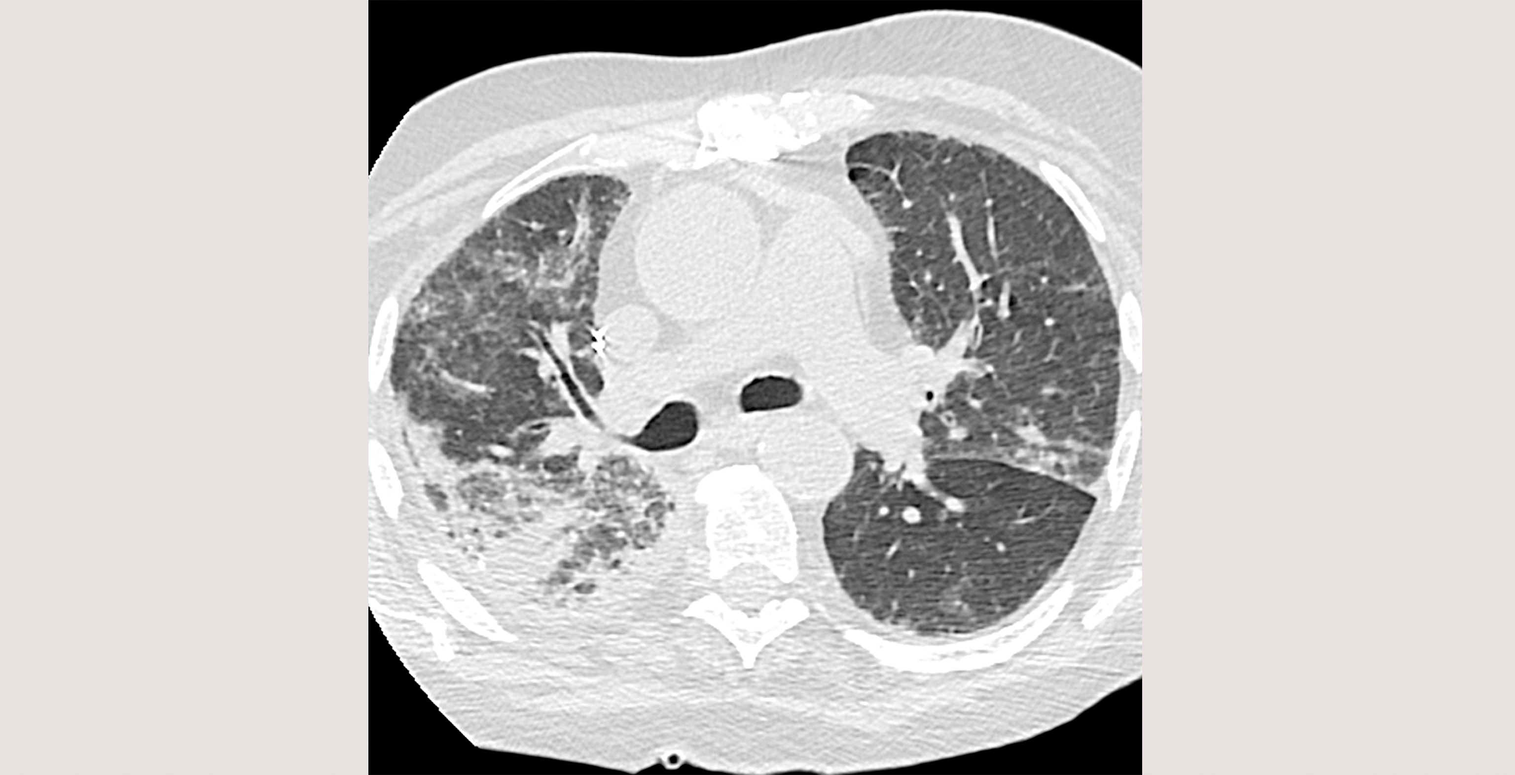 3P-1-3-radiology-viral-pneumonia