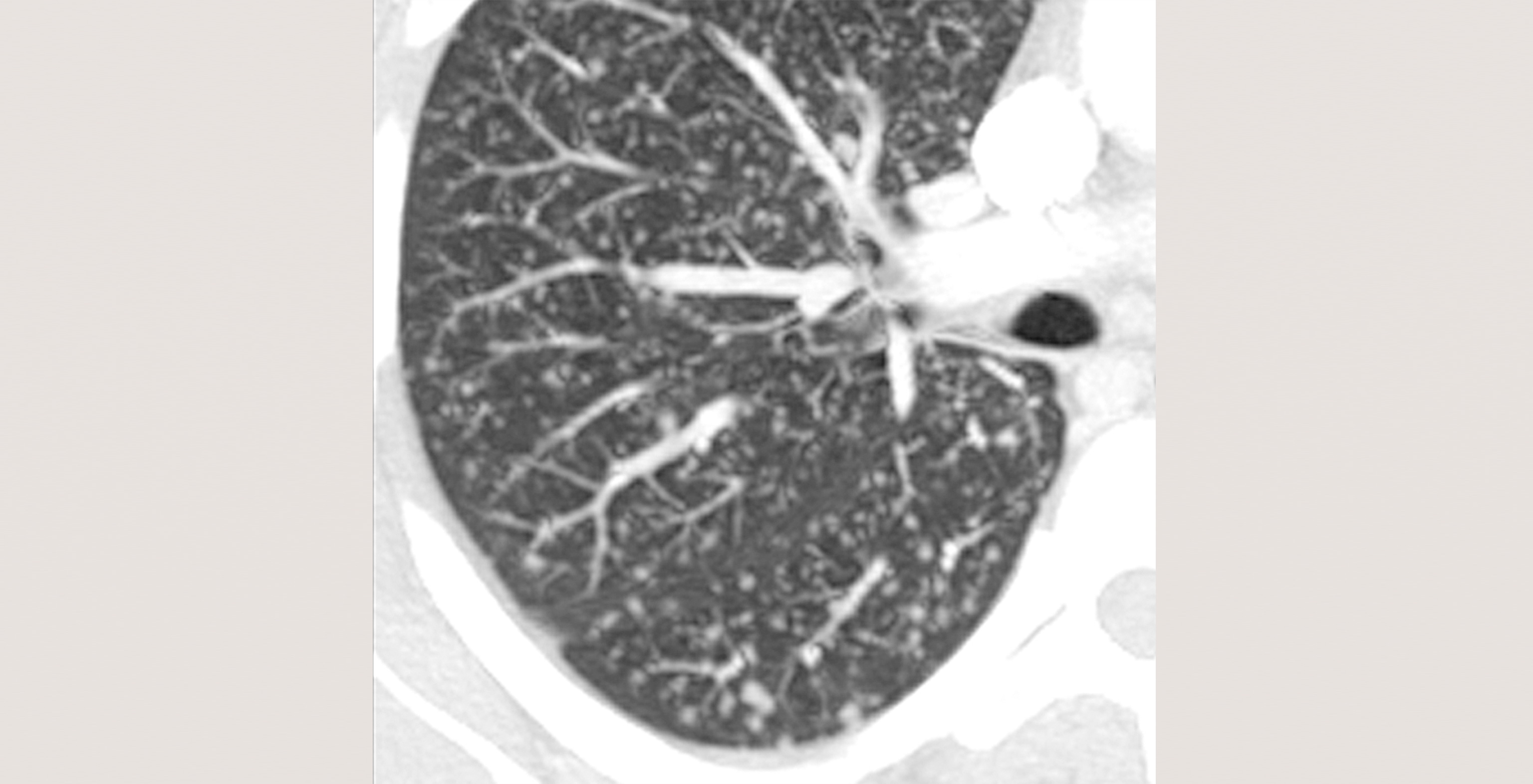 9-p4-5-radiology-viral-pneumonia