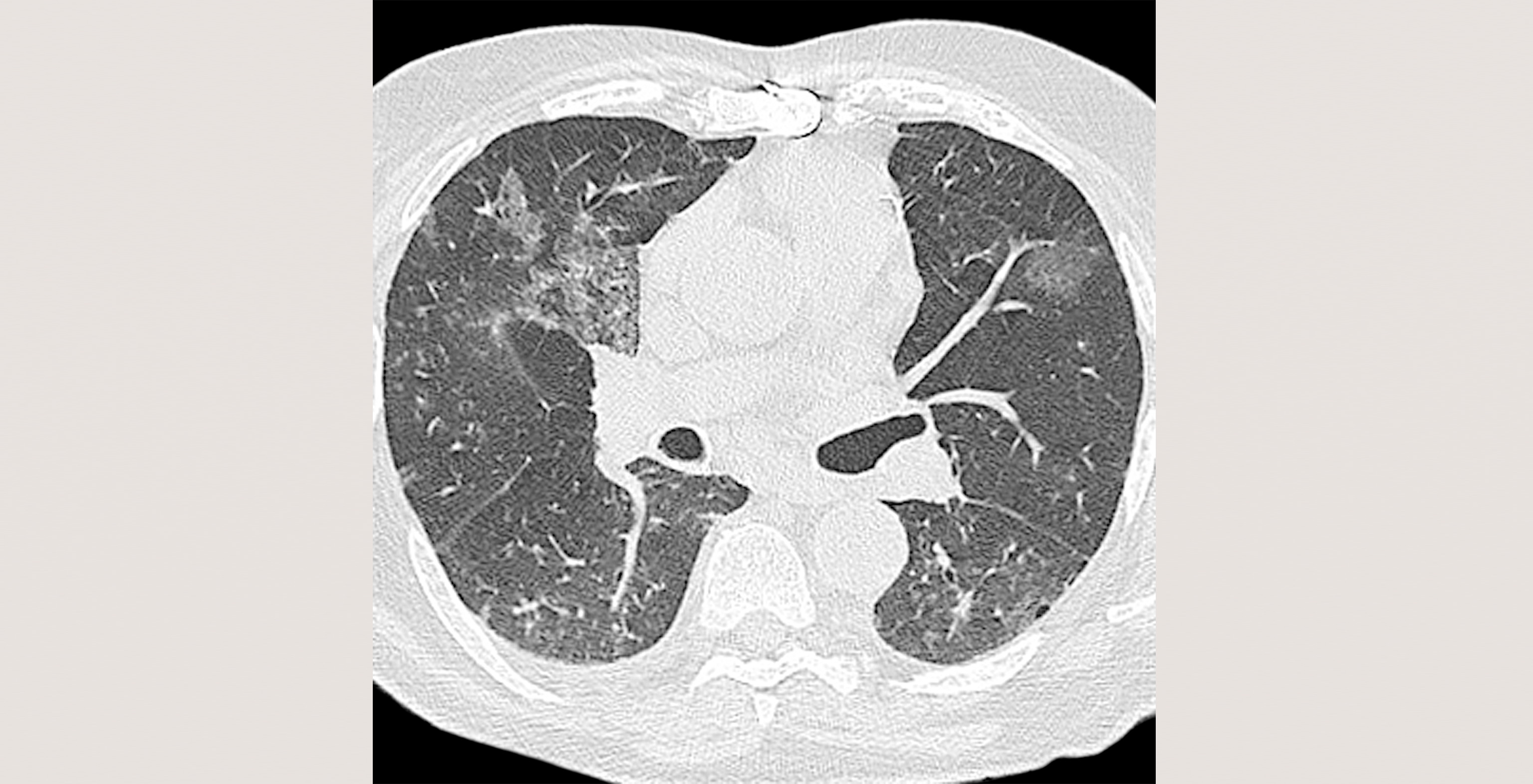 5-p4-1-radiology-viral-pneumonia