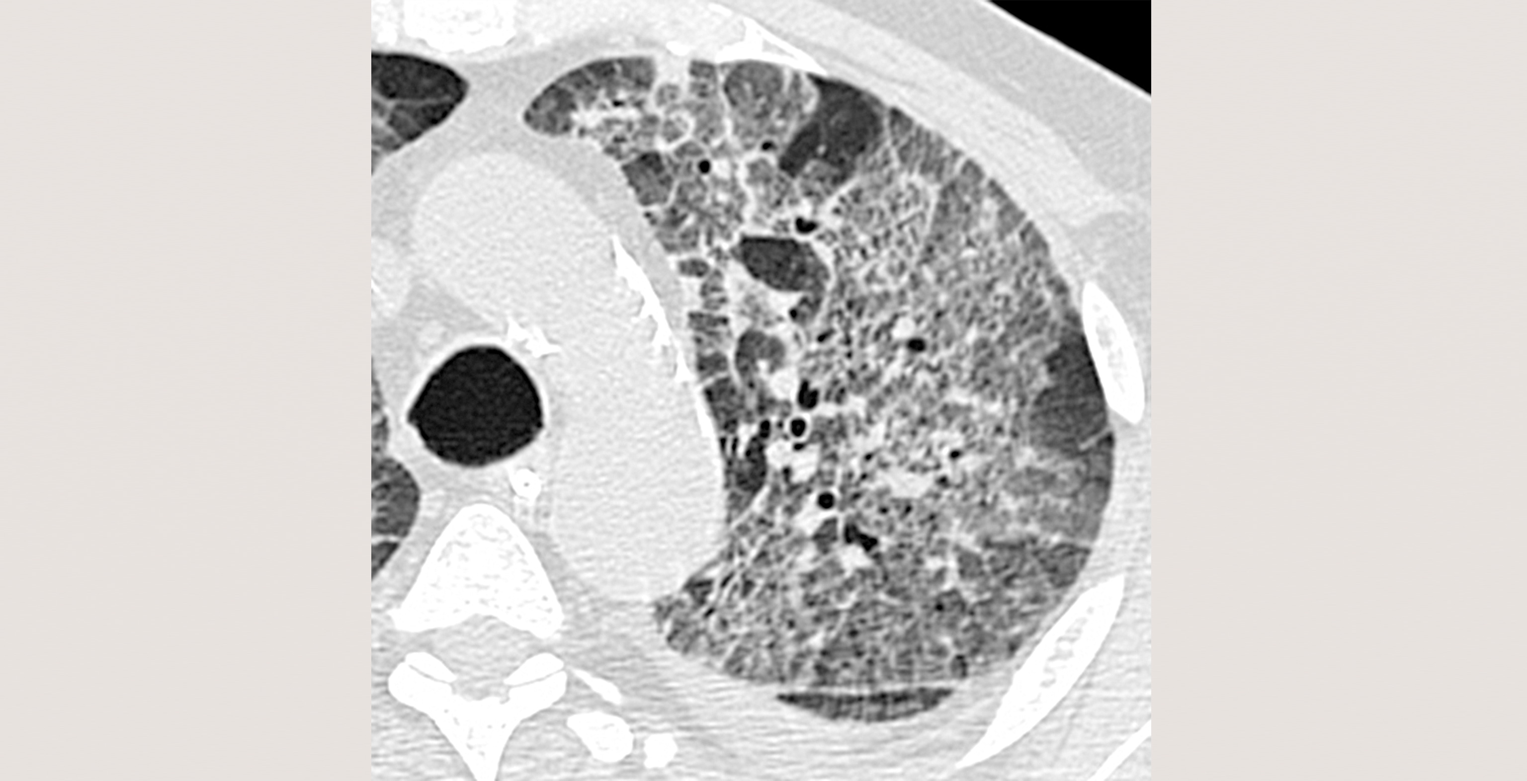 10-p4-6-radiology-viral-pneumonia