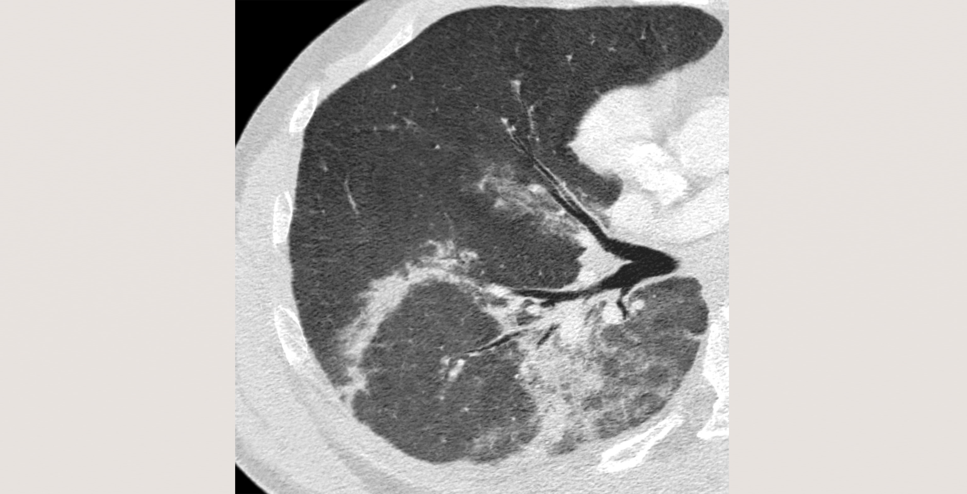 d4-radiology-viral-pneumonia