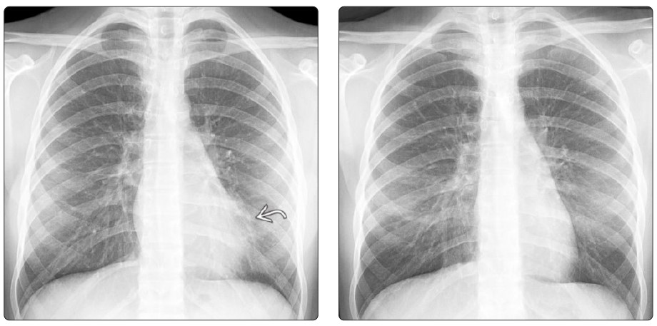PA chest dyspnea-left heart
