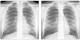 PA chest dyspnea-left heart