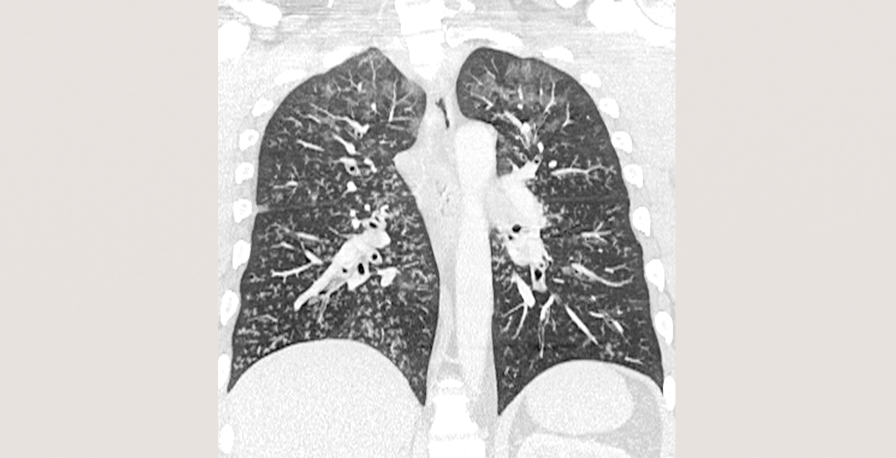 1-p1-1-radiology-viral-pneumonia