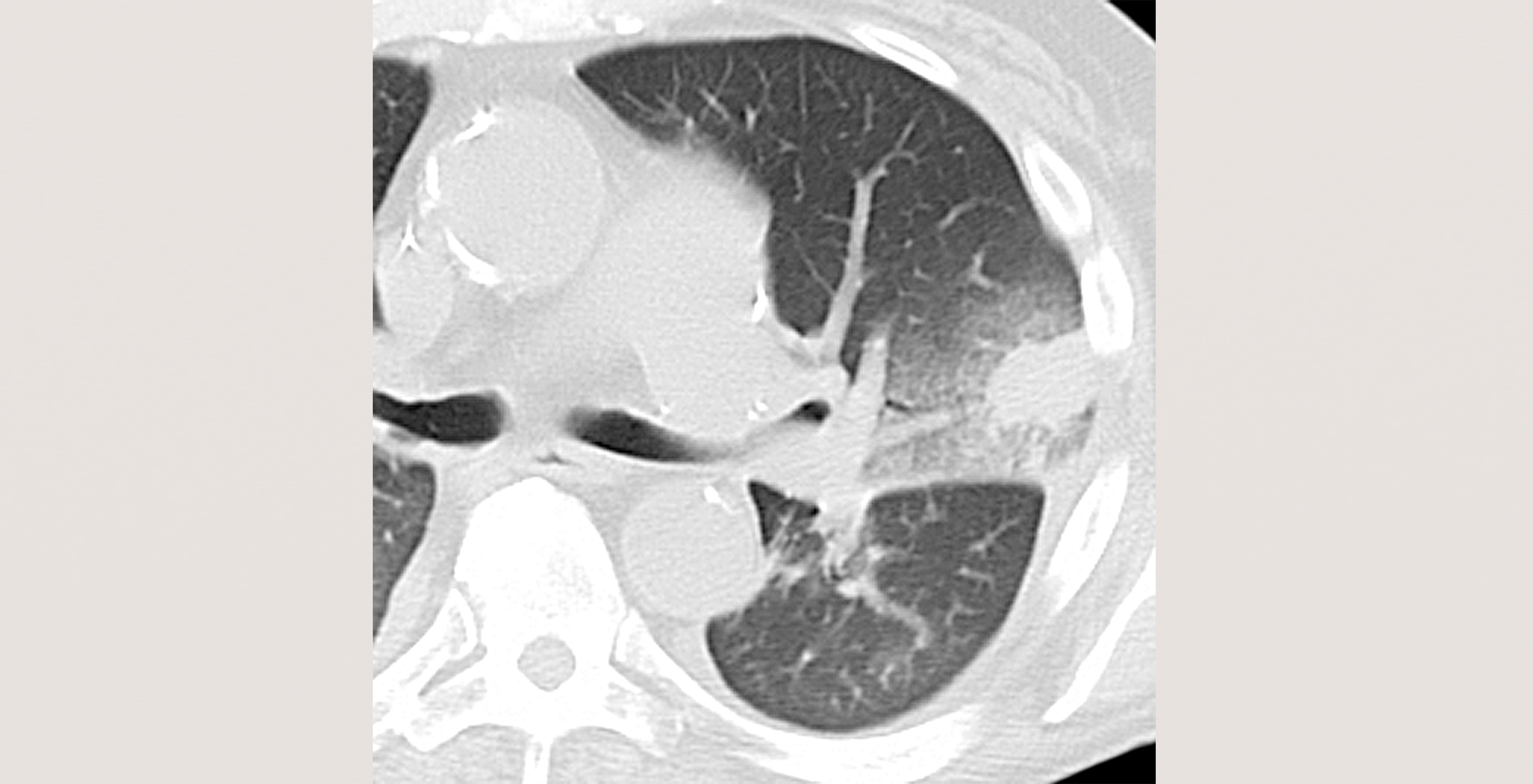 7-p4-3-radiology-viral-pneumonia