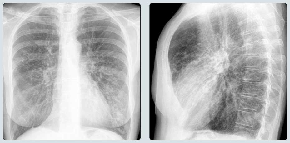 PA-chest-radiograph