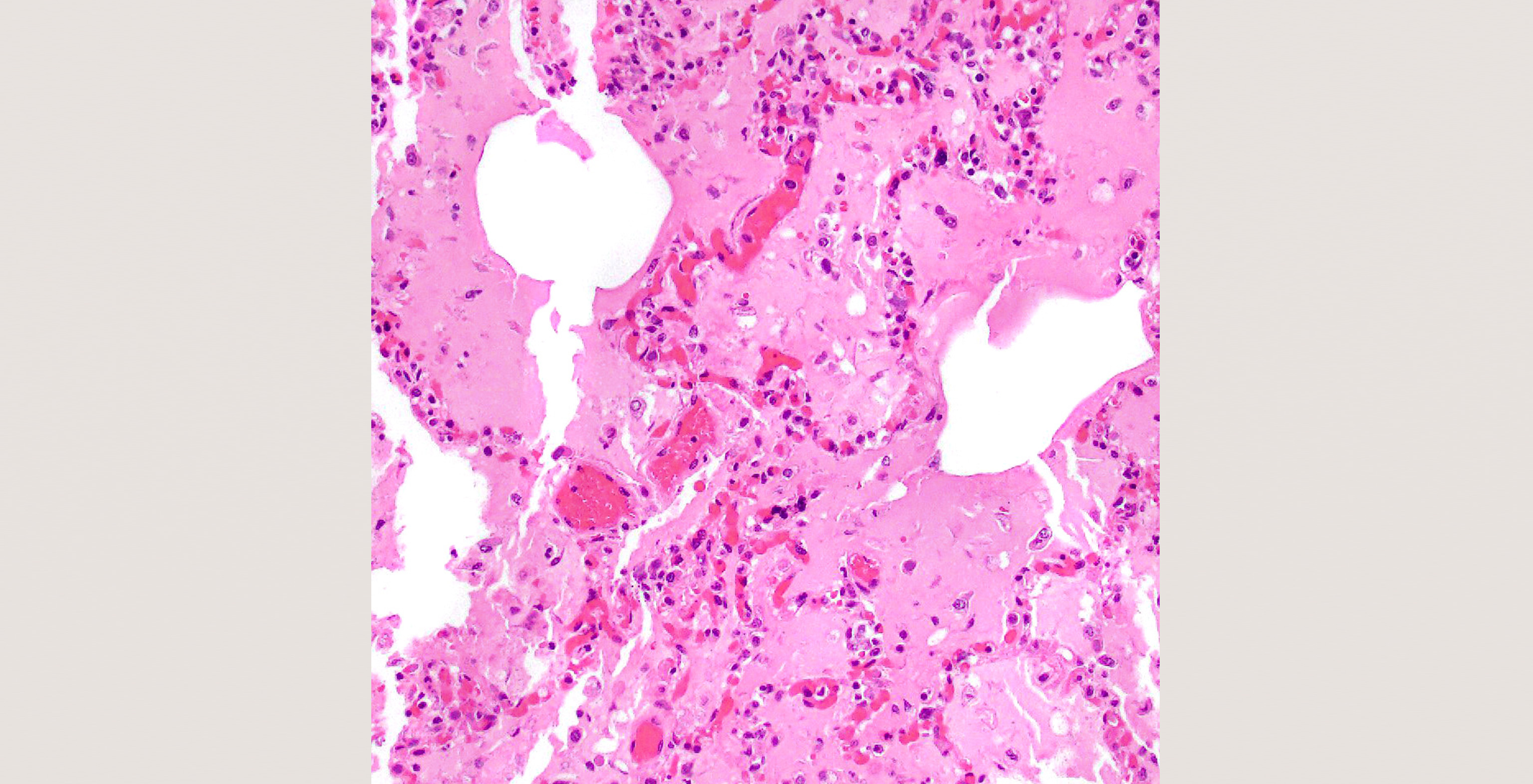 3-p4-1-pathology-sars