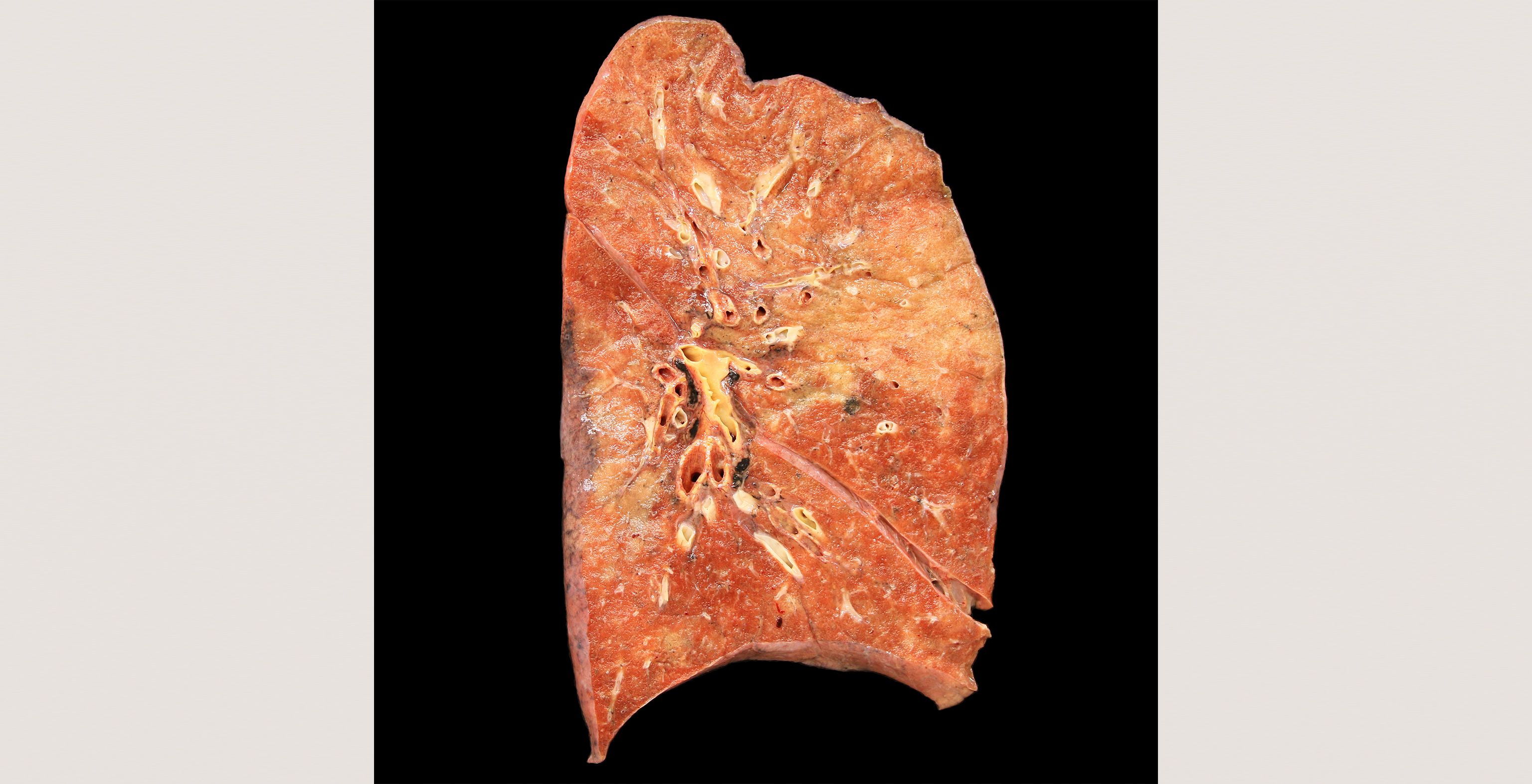 2-p1-2-pathology-sars