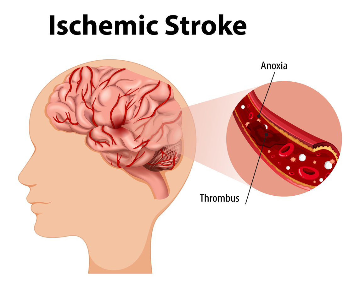 Ischemic Stroke iStock-1403932407