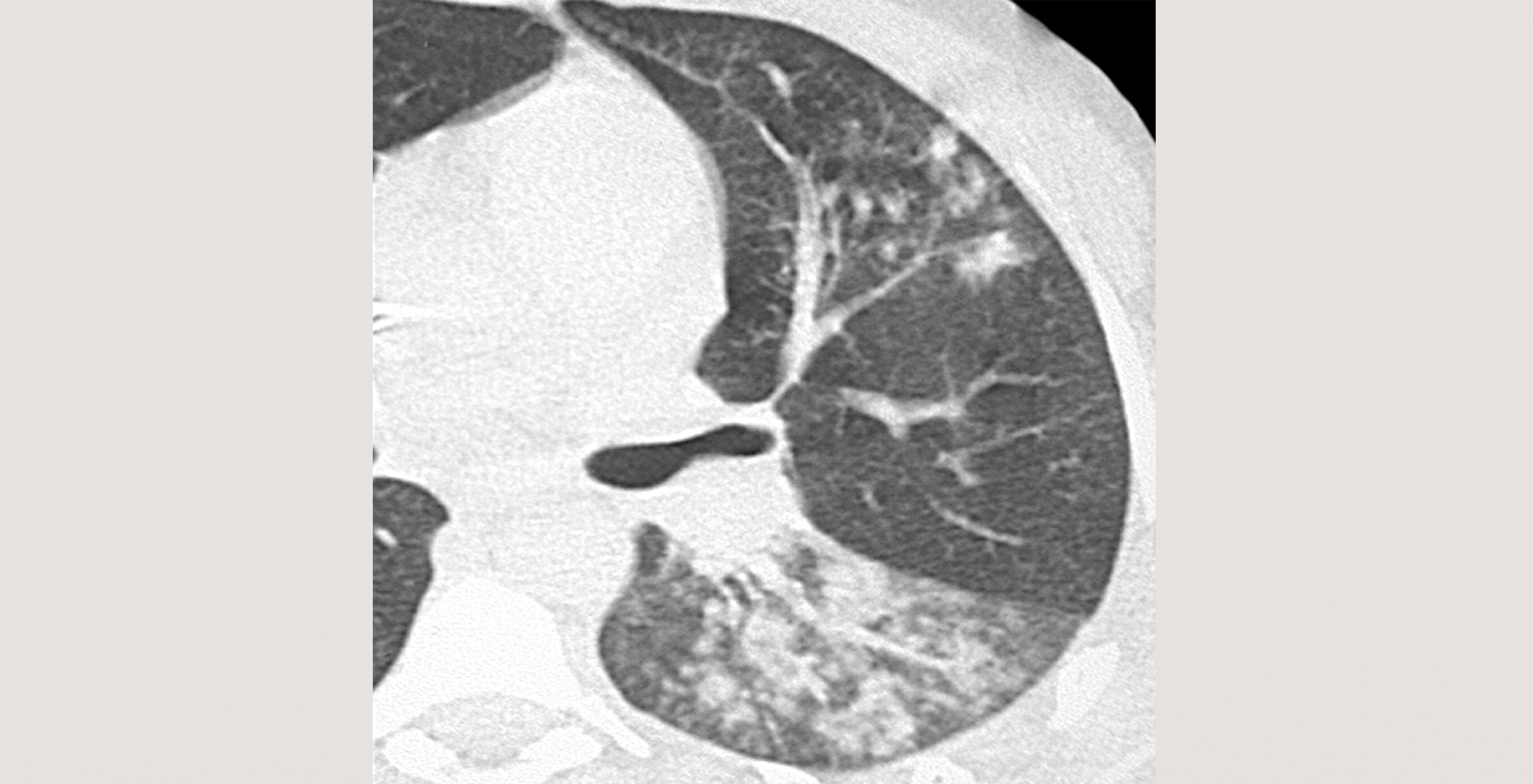 d6-radiology-viral-pneumonia