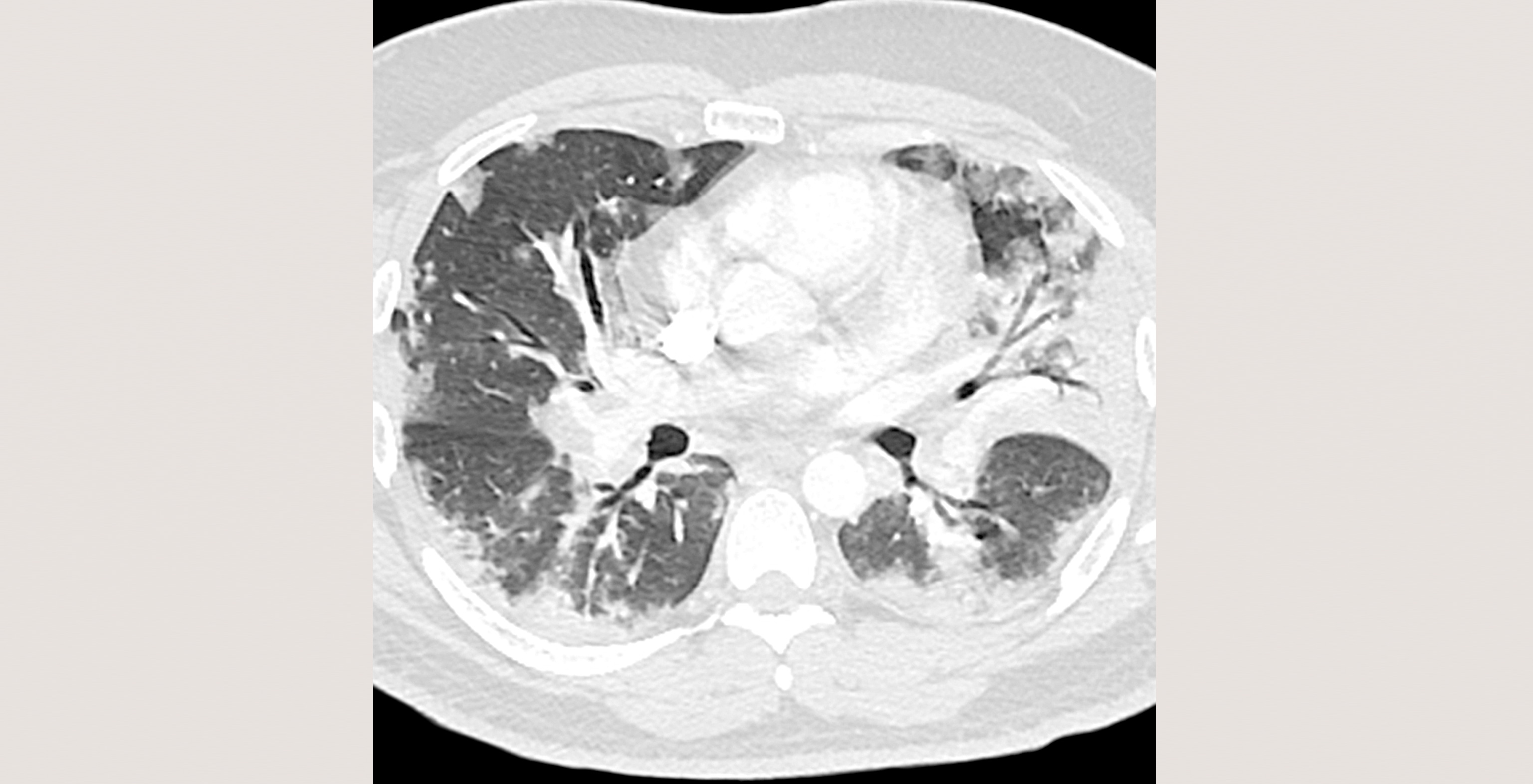 d1-radiology-viral-pneumonia