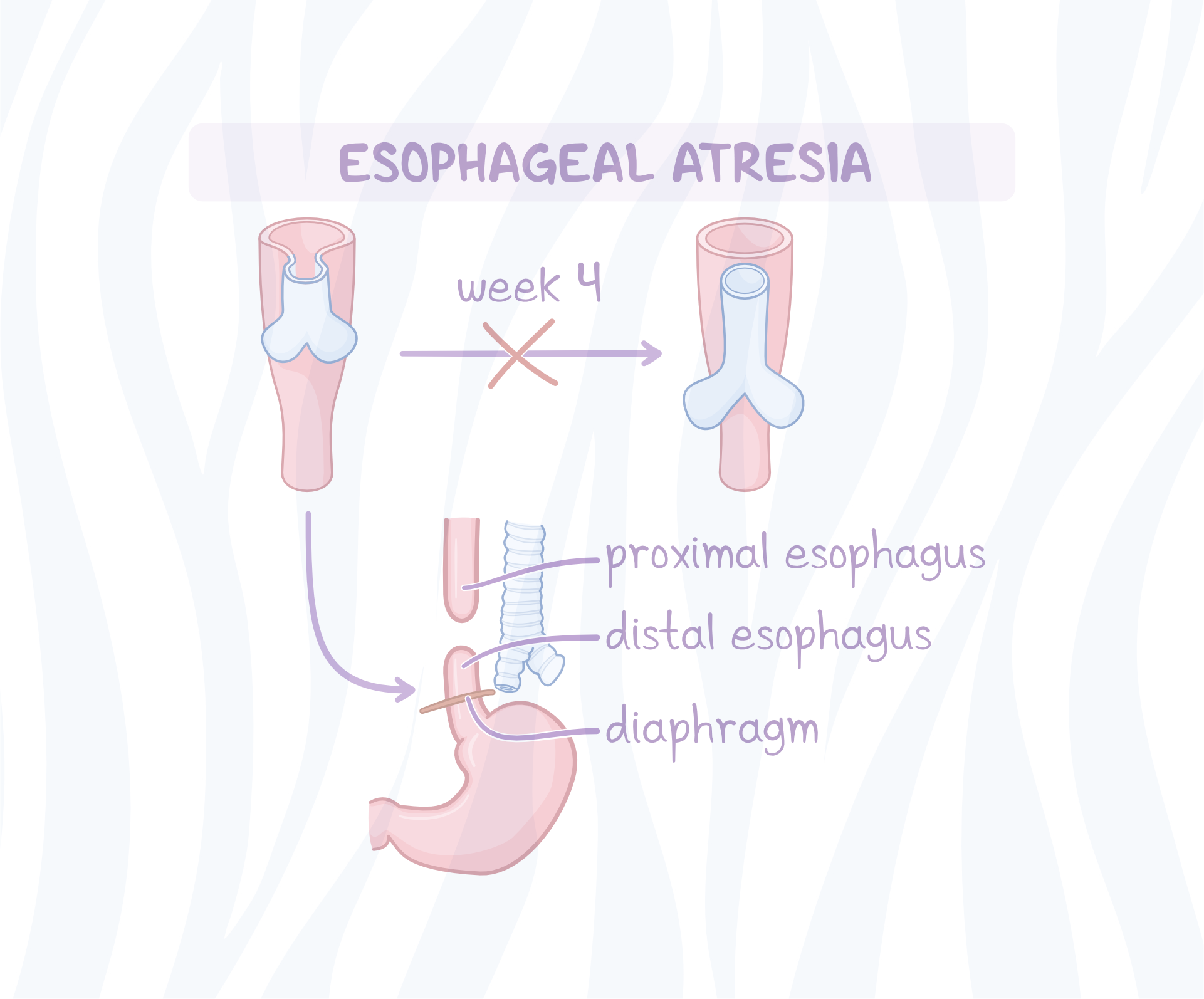esophageal atresia repair