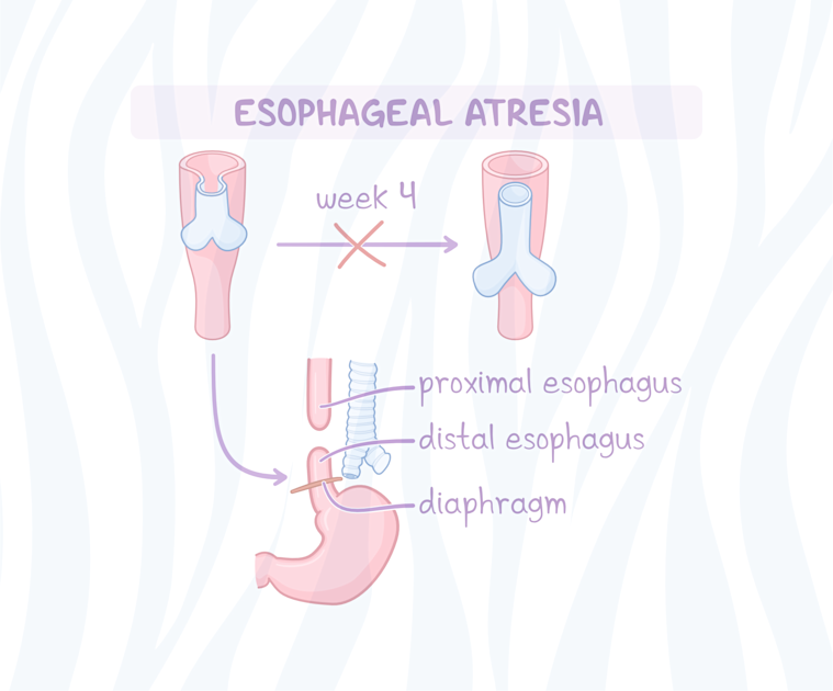 Esophageal Atresia And Tracheoesophageal Fistula 6362