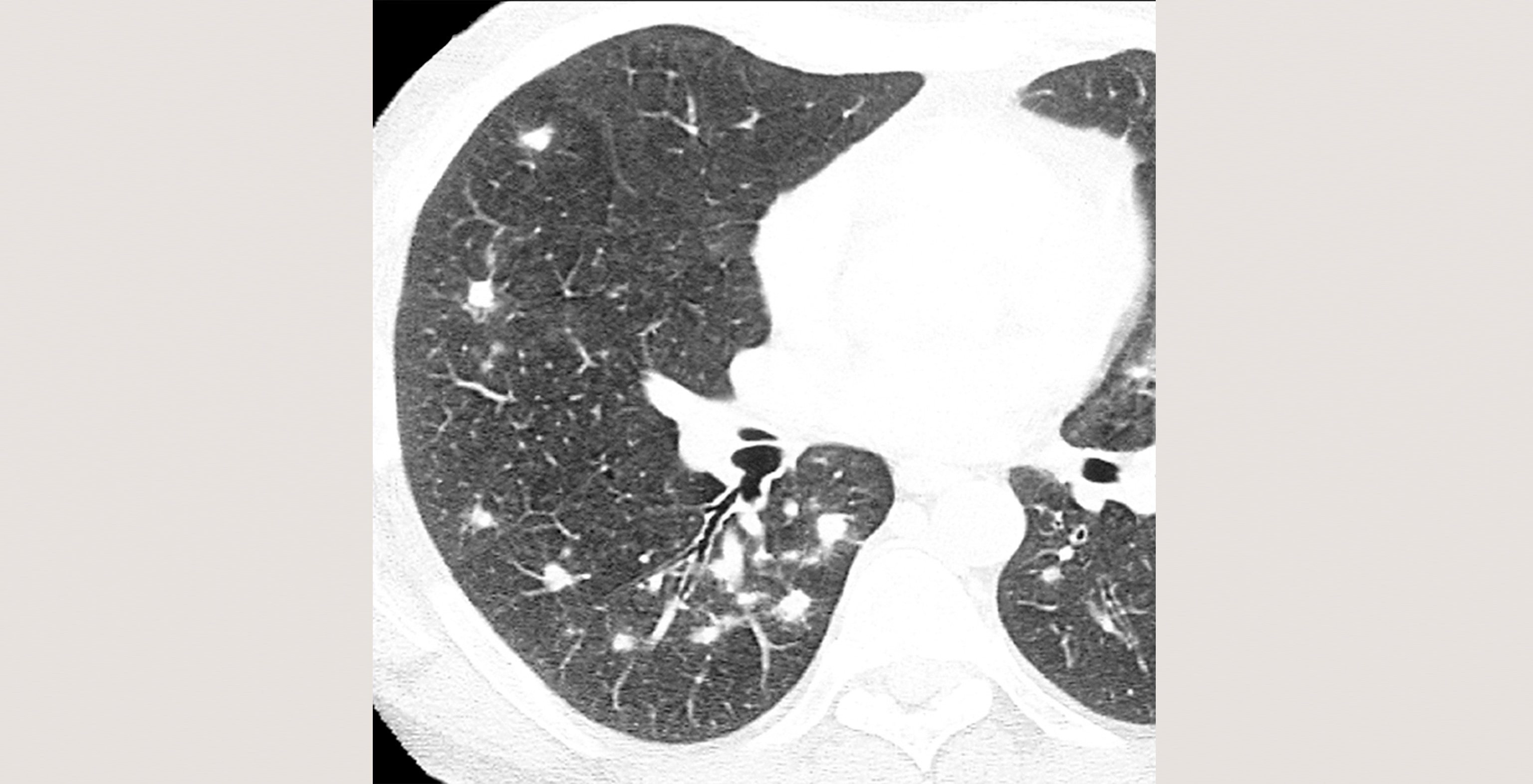 8-p4-4-radiology-viral-pneumonia