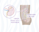 Card Thumbnail-Retroperitoneal Fibrosis