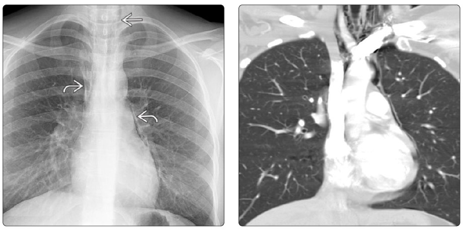 pa chest acute dyspnea