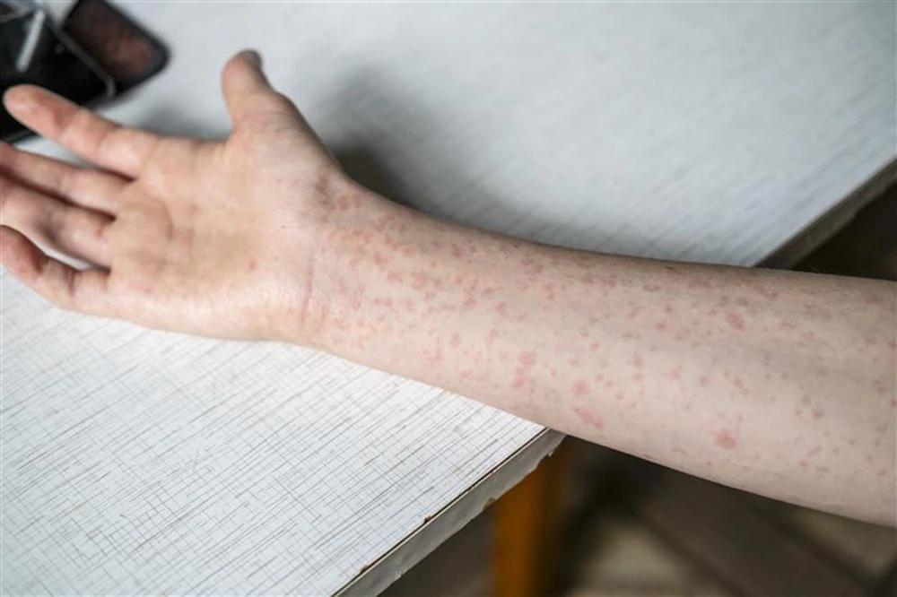 Teenager with measles rash on arm.