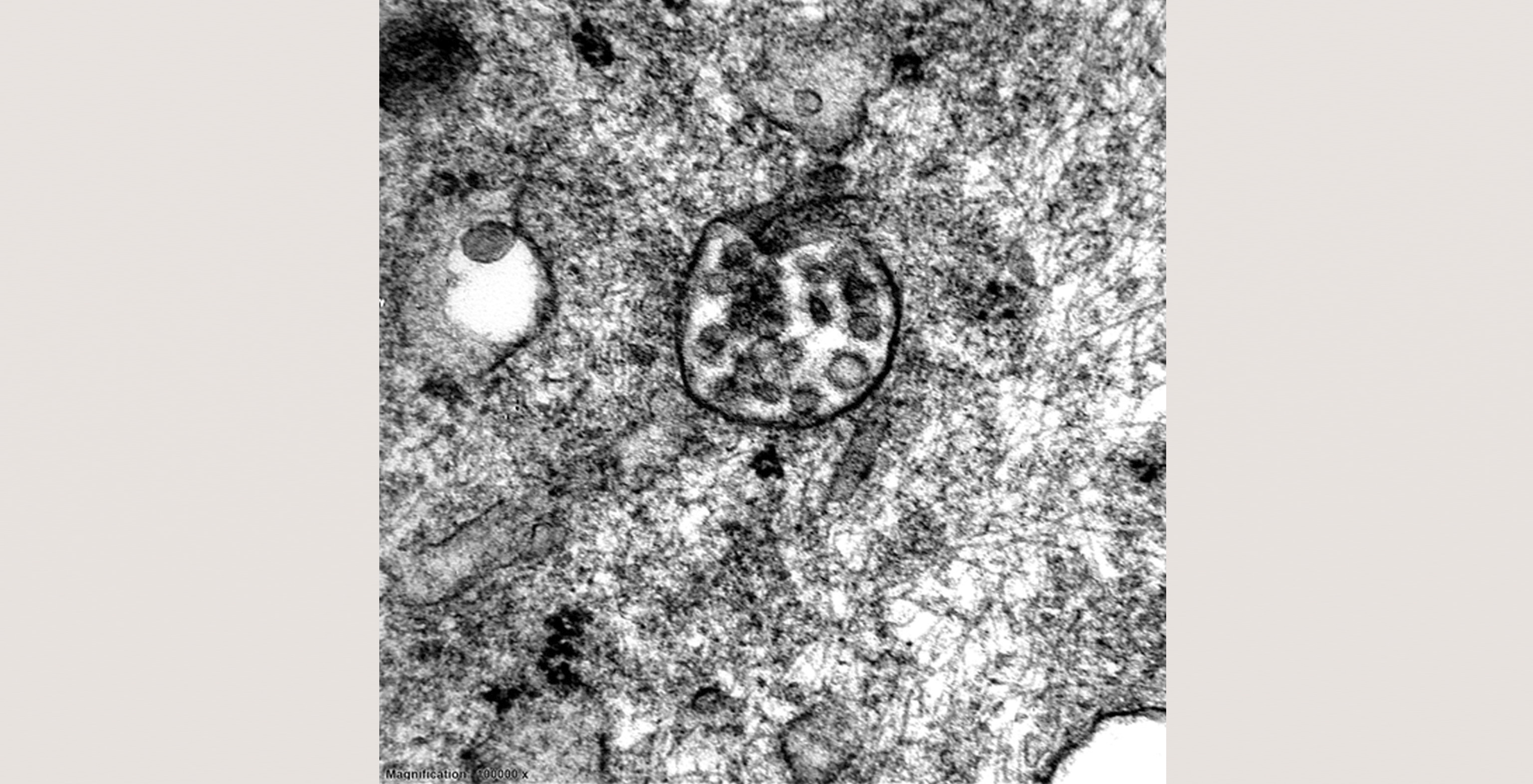 pathology-nephrology-d2