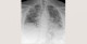 6-p4-2-radiology-chest