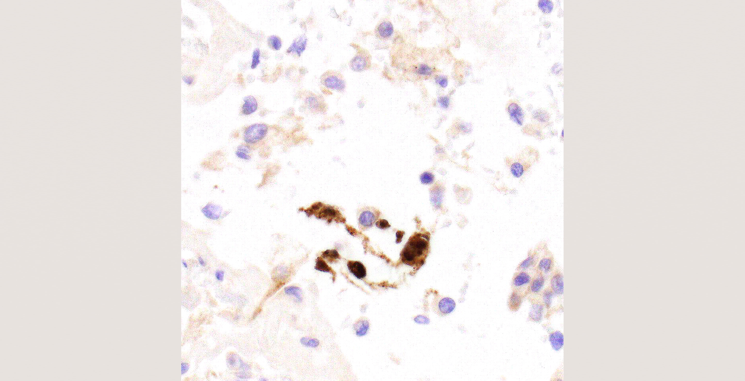 16-p6-2-pathology-sars