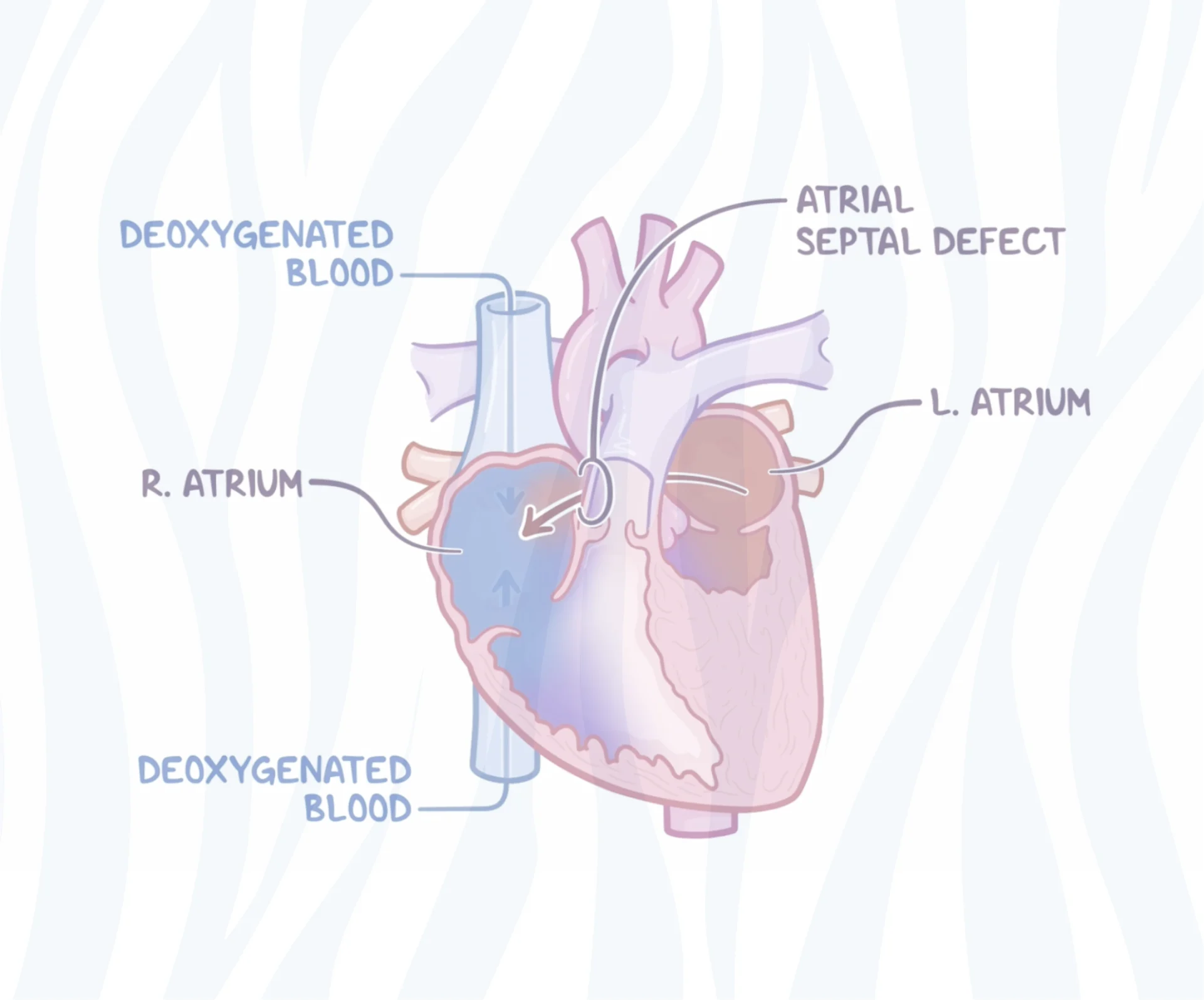 zebra_Hypoplastic Left Heart Syndrome video