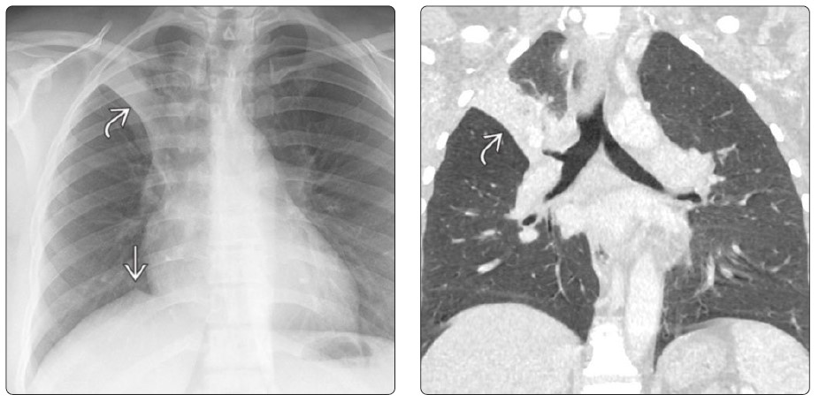 PA chest right upper lobe