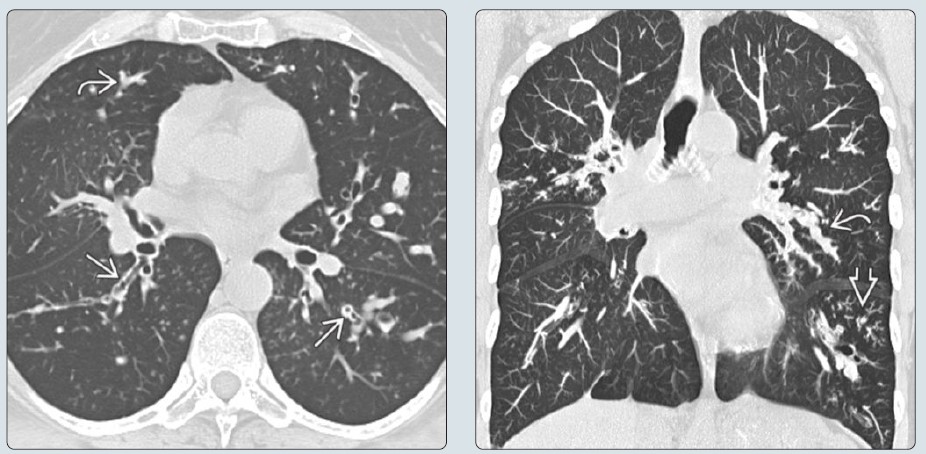 Axial NECT chest