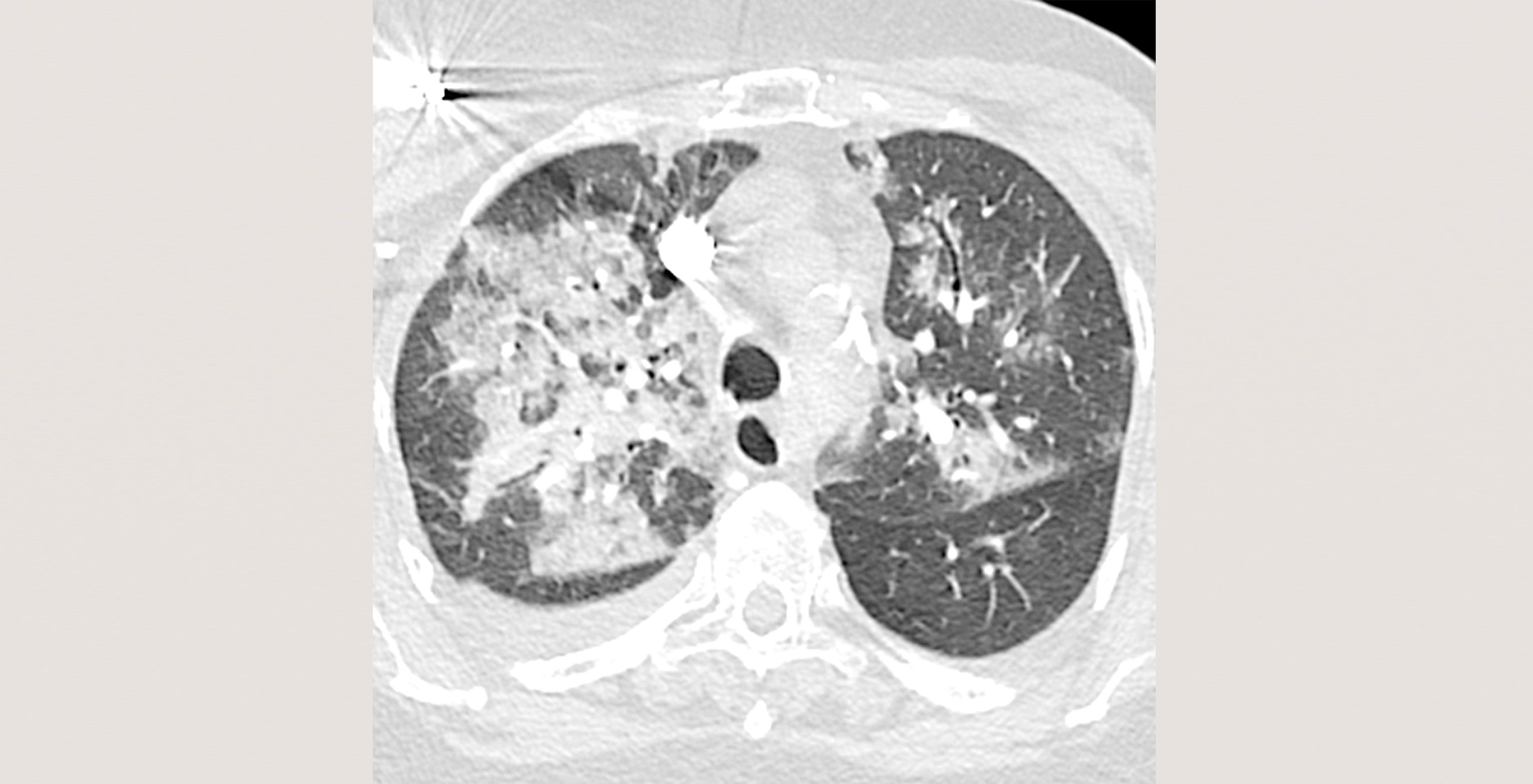 4-p1-4-radiology-viral-pneumonia