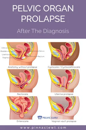 Pelvic Organ Prolapse Diagram