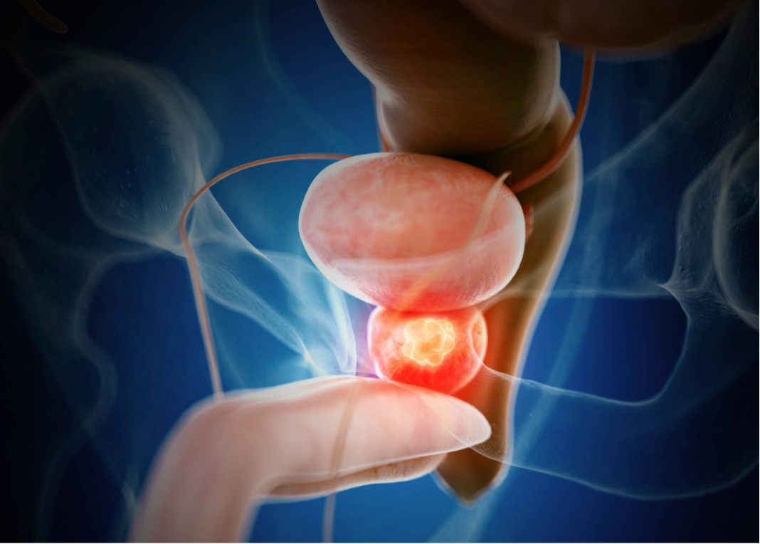 Can Pelvic Floor Physical Therapy Help Keep My Prostate Healthy Pelvic Health Physical 6406