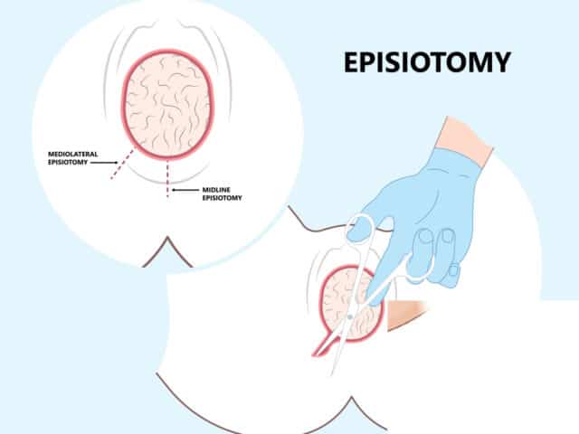 Episiotomy Image