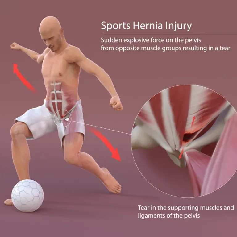 sports hernia