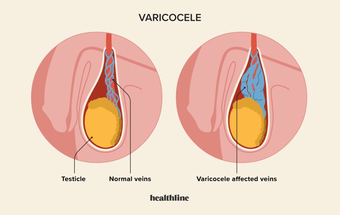 varicocele