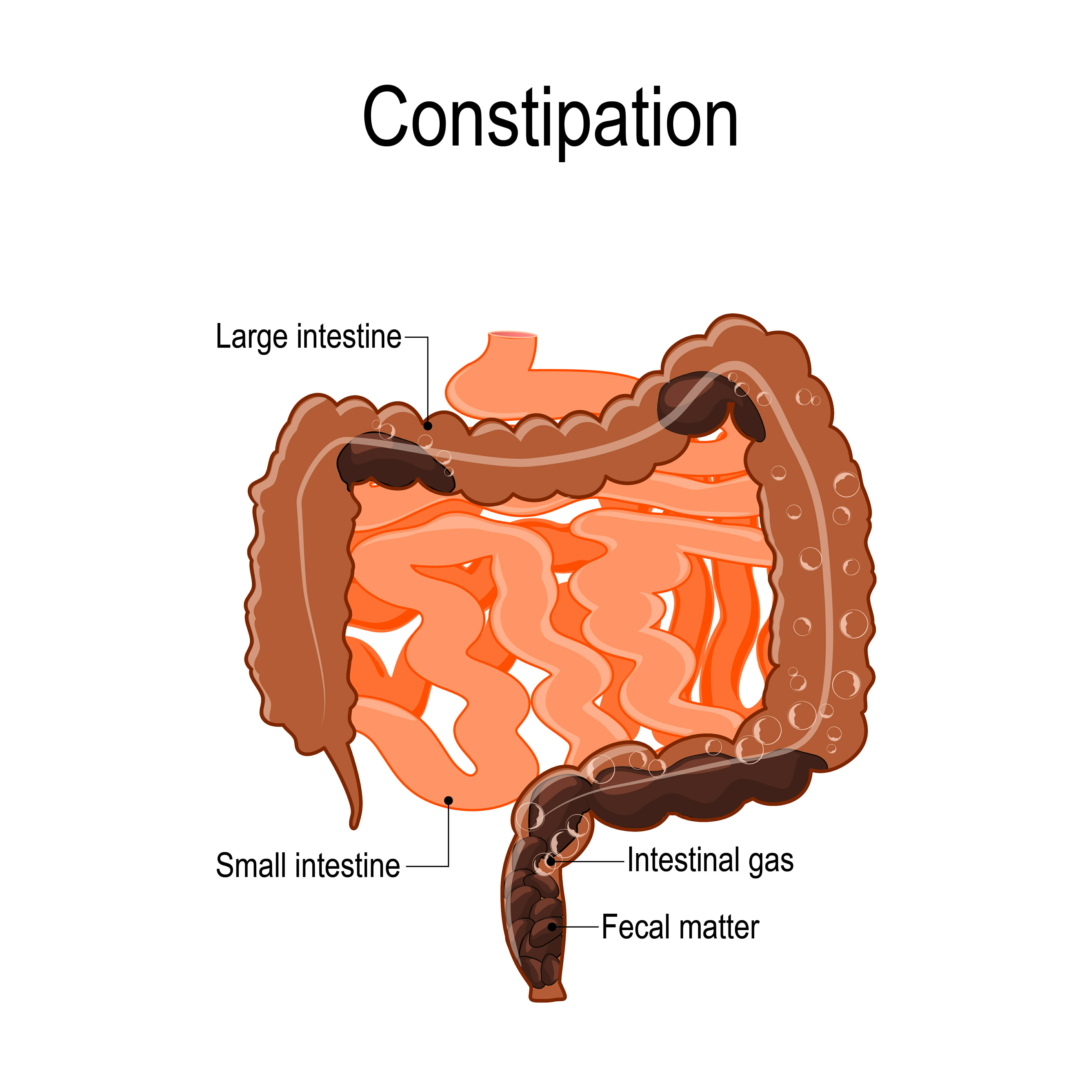 what causes constipation in women        <h3 class=