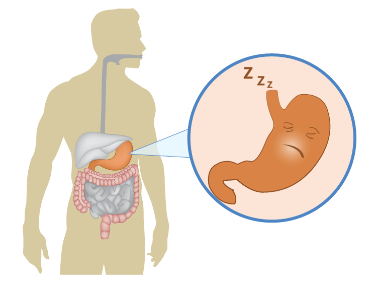 gastroparesis