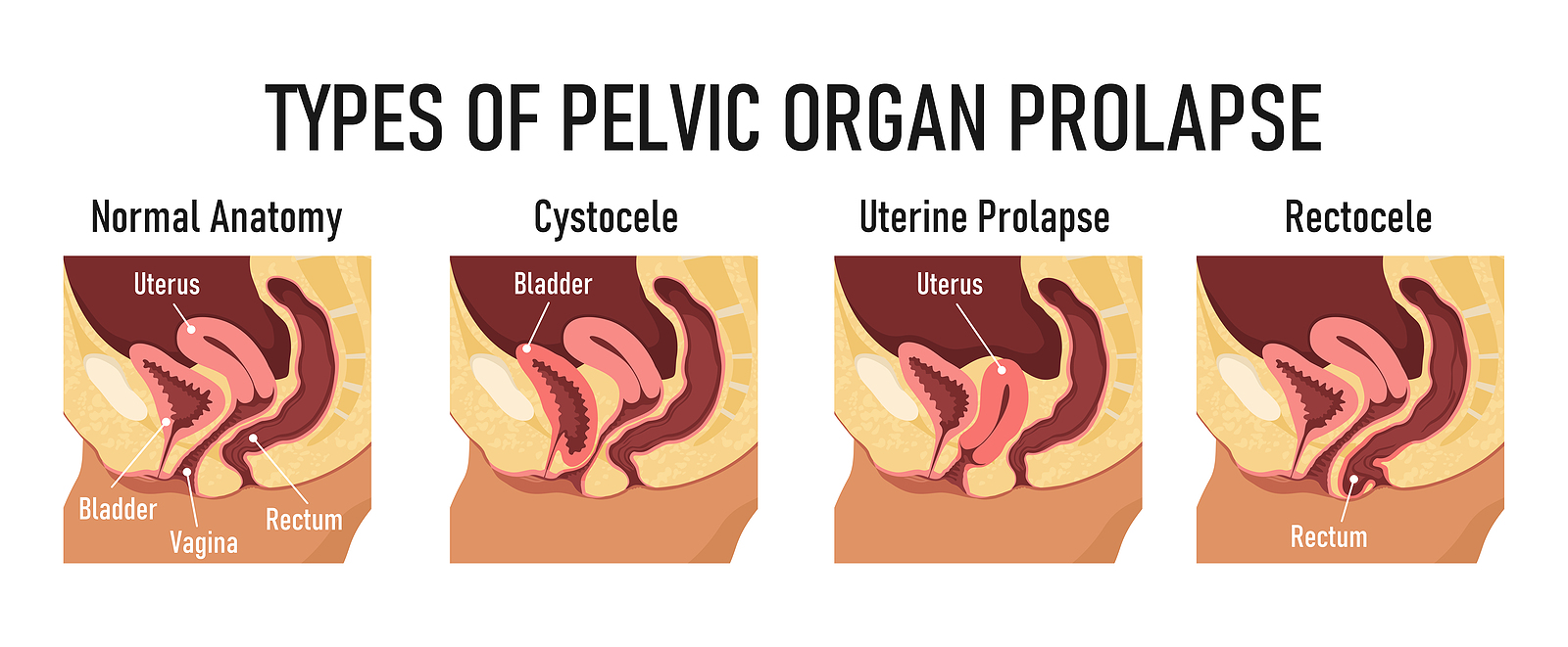 Diagram of Pelvic Organ Prolapse