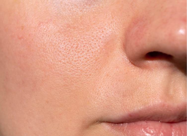 CicatricesDeAcne--mifarma-blog-body-2
