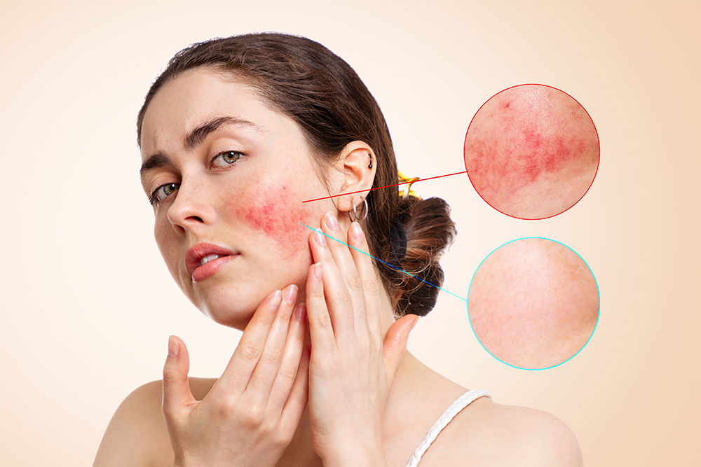 que es la rosacea