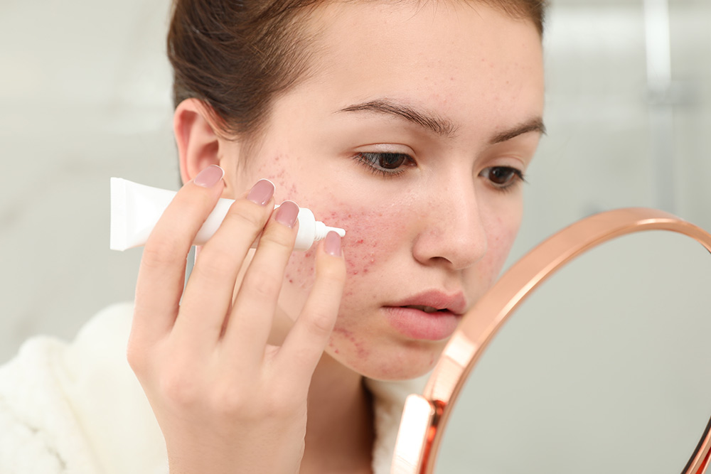 Acne 2