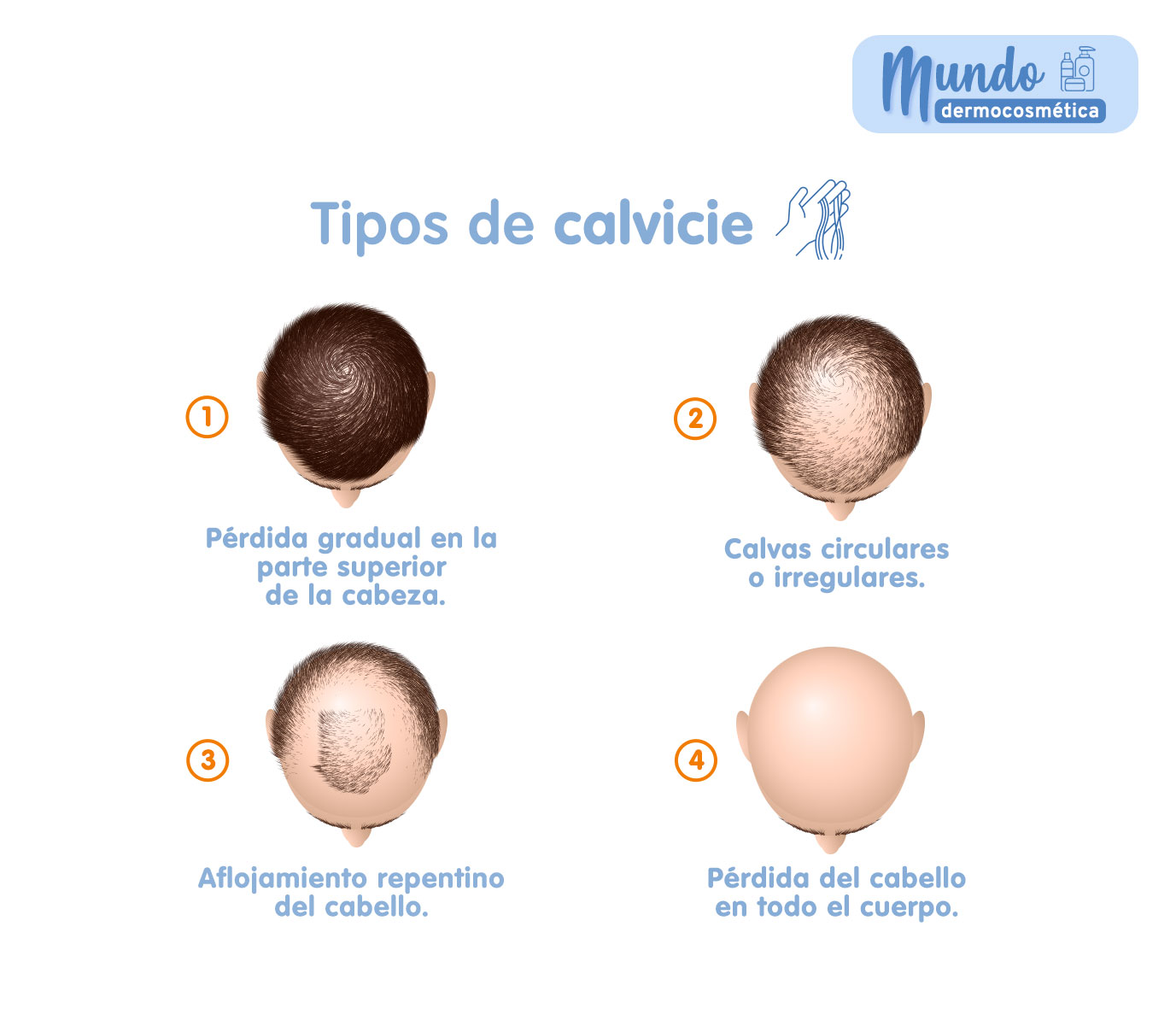 infografía tipos de calvicie