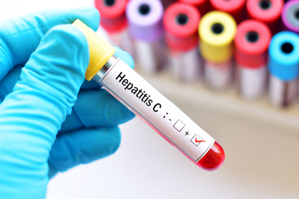 que es la hepatitis c