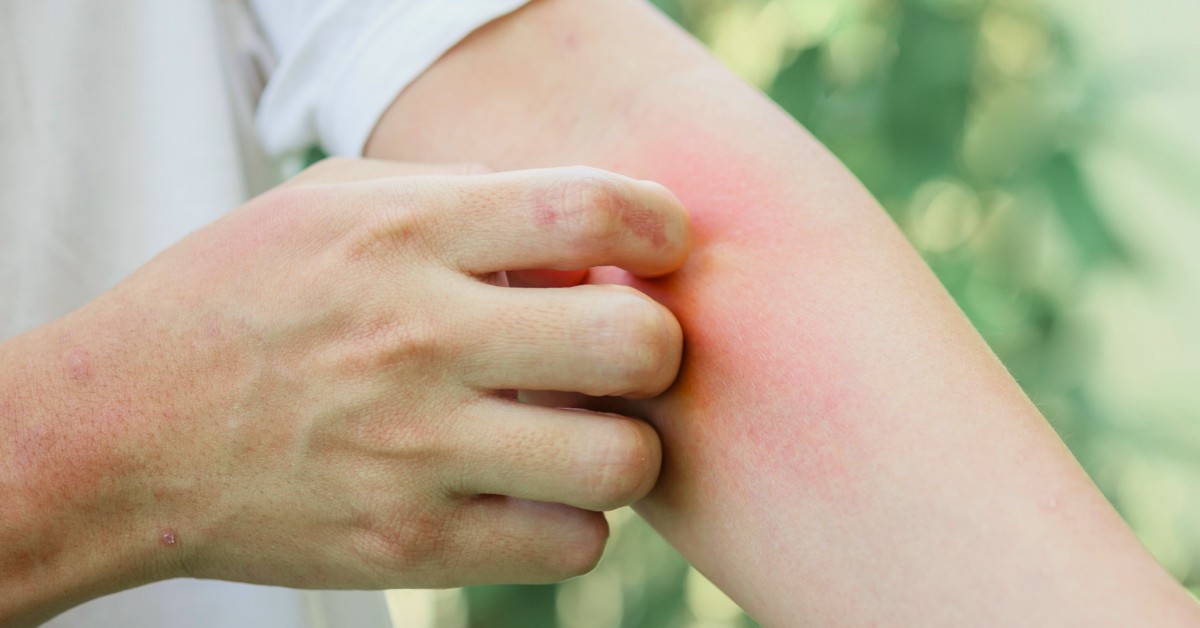 Celulitis