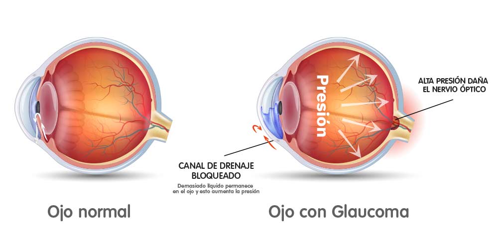 glaucoma 02