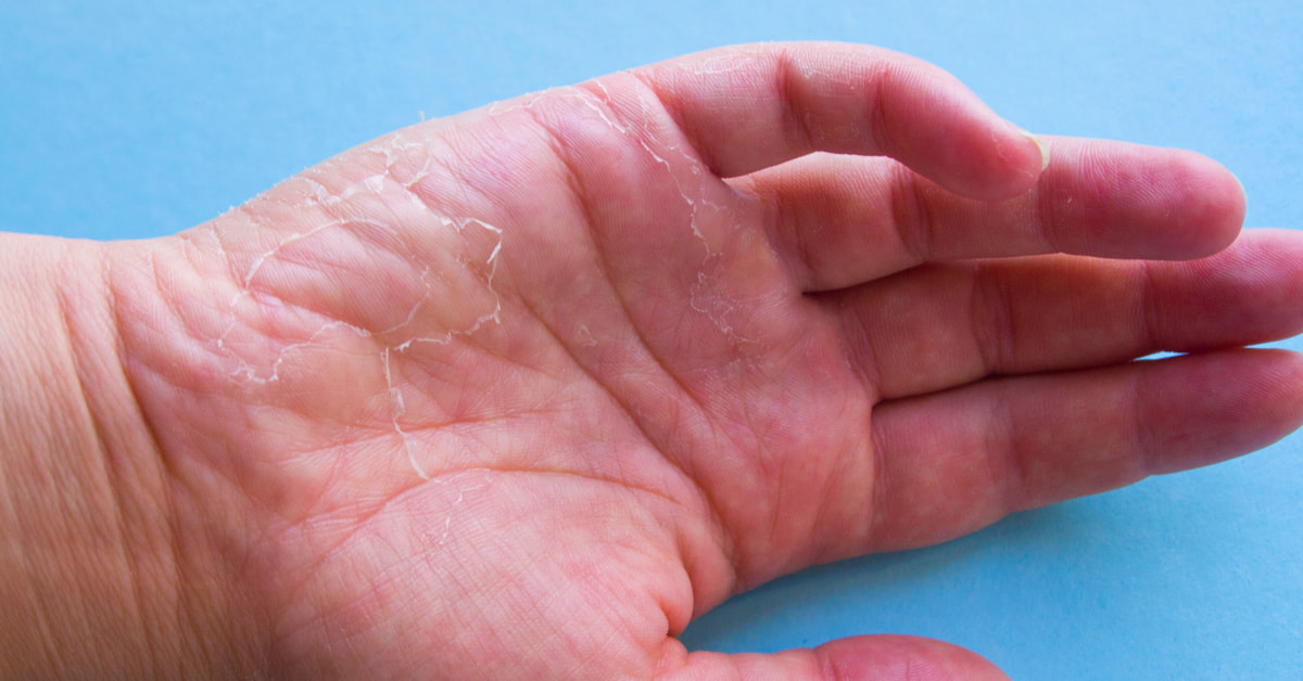 piel de la mano seca 1