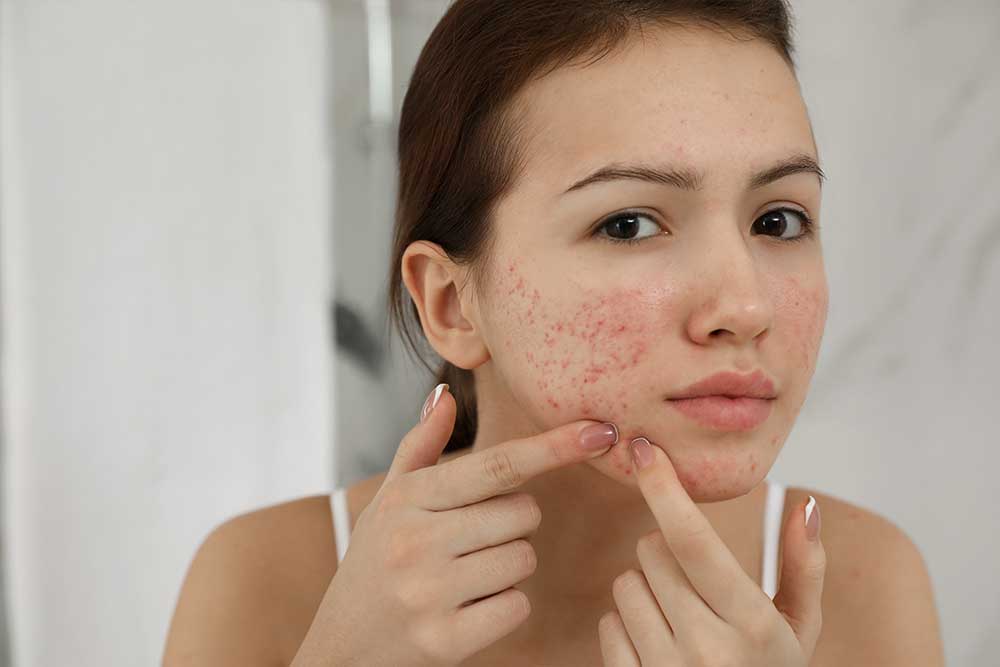 acne-rosacea-hiperpigmentacion 1